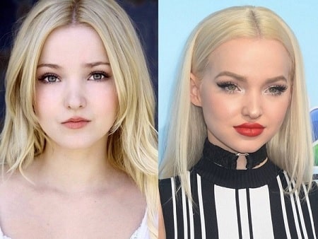 A before and after picture of Dove Cameron showing the change in her nose.